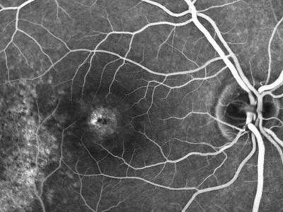 image of macular hole, fluorescein, angiography, dye