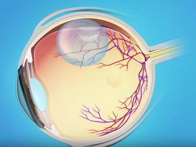 patient education, video, dry amd
