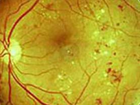 image of diabetic eye disease