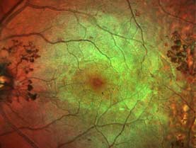 proliferative diabetic retinopathy, pdr