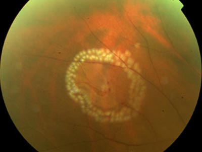 laser procedure, retinopxy