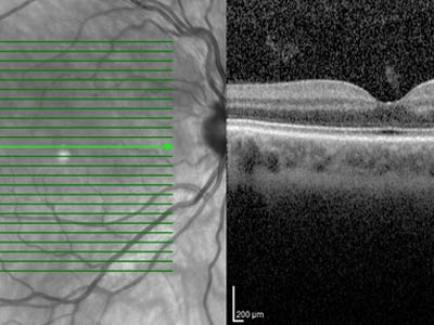 optical, coherence, tomography, oct