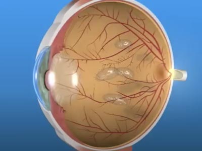 floaters and flashes, retina eye, vitreous floaters, seeing floaters, seeing flashes